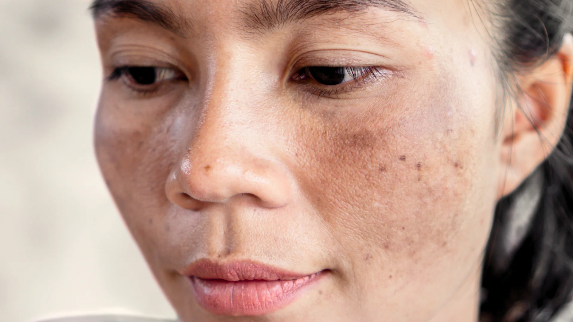 Dark Spots or Pigmentation